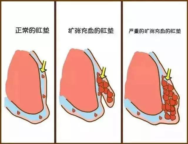 痔疮是人类直立行走的代价吗？如何避免成为有“痔”之士？