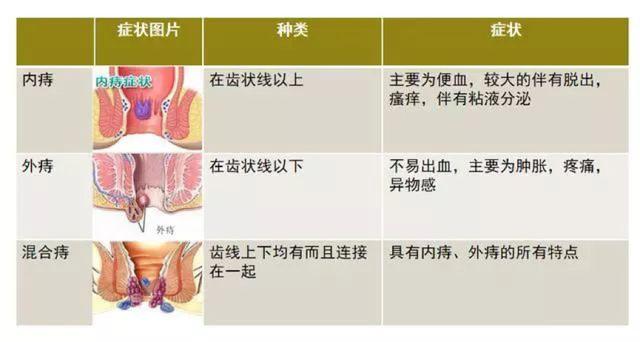 无症状的痔疮可以不治疗.1.